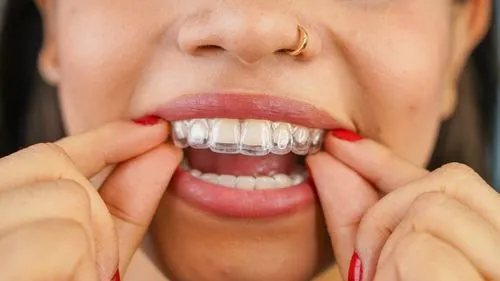 Close-up of woman inserting a clear invisible braces aligner on her teeth.