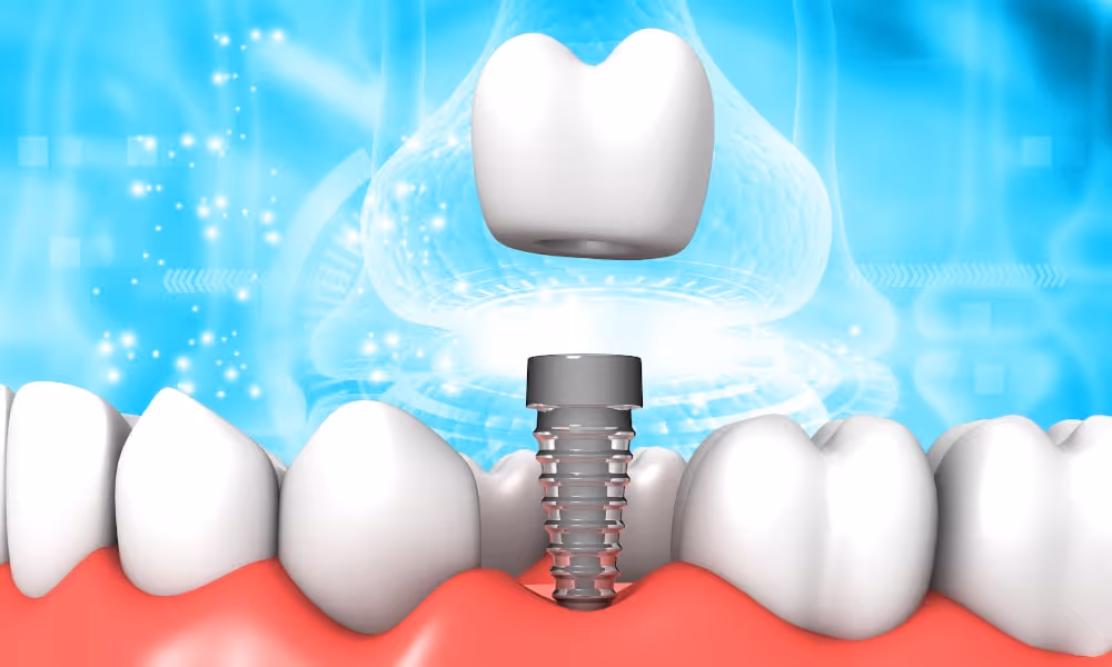 Dental implants are often quite expensive without insurance