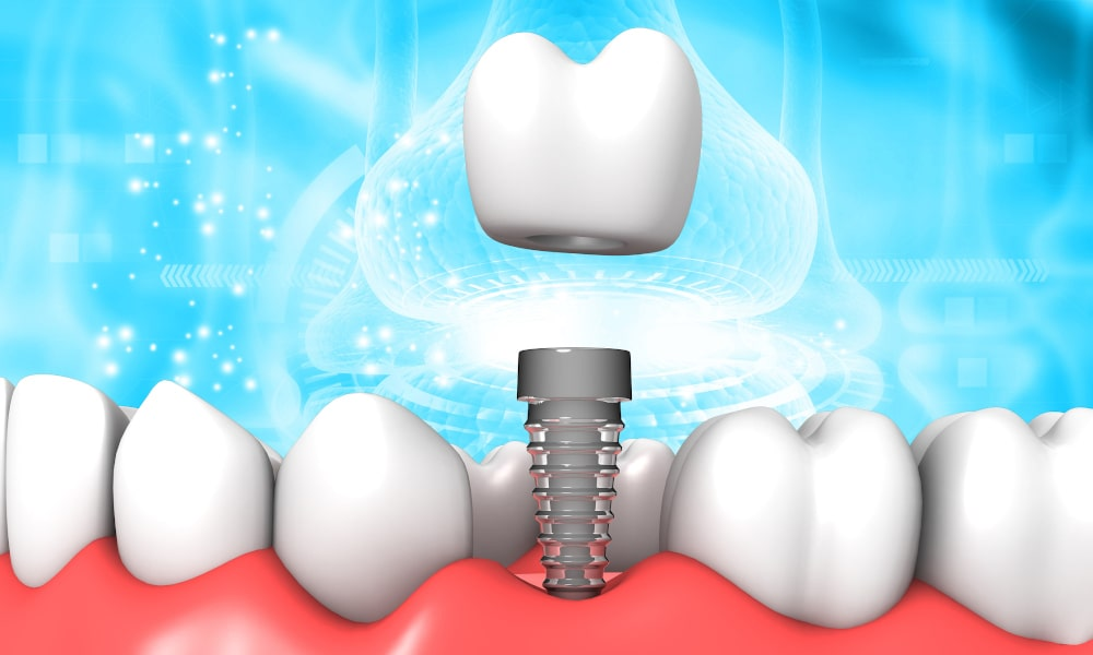 Dental implants are often quite expensive without insurance