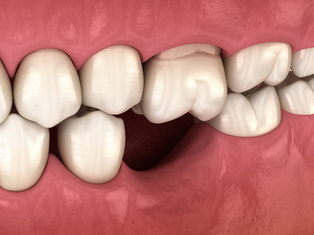 How Molar Implants Restore Your Chewing Power