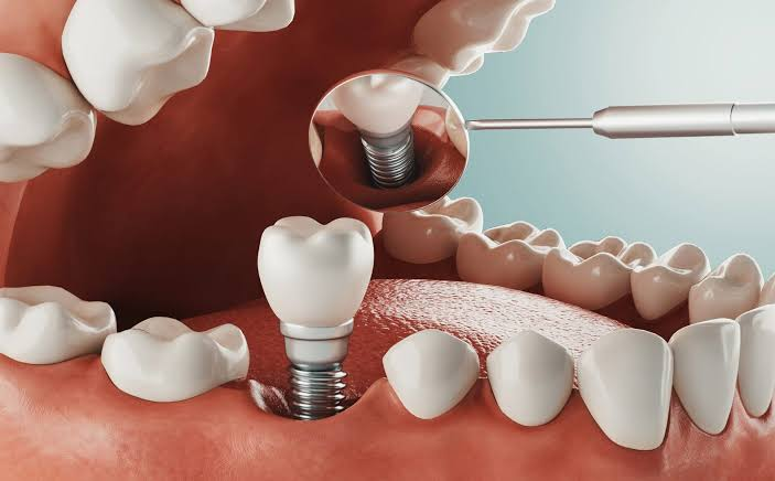 Why Dental Implants Are the Closest Thing to Natural Teeth