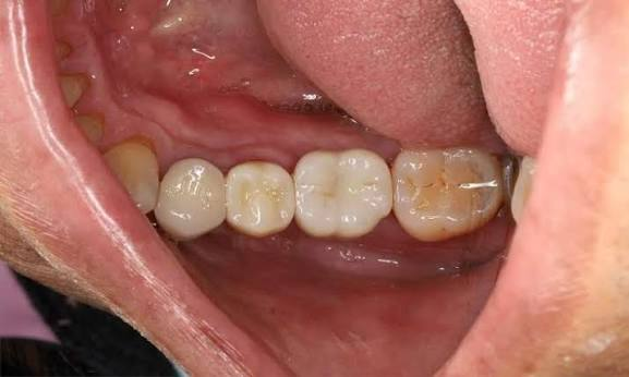 How Much Chewing Strength Can You Regain?