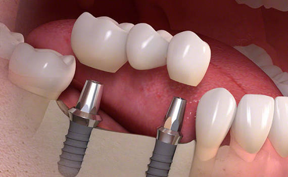How Molar Implants Restore Your Chewing Power