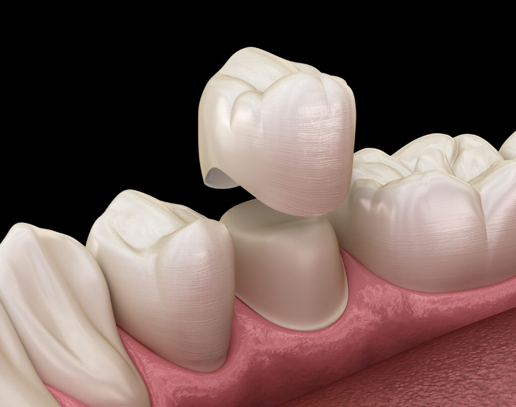 What Should You Do First If Your Dental Crown Comes Loose?