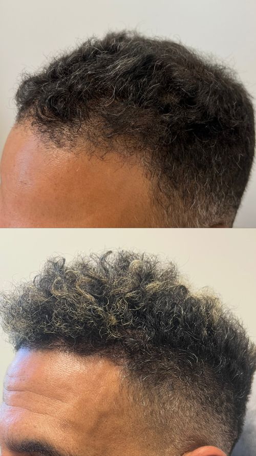 Our hair restoration before and after