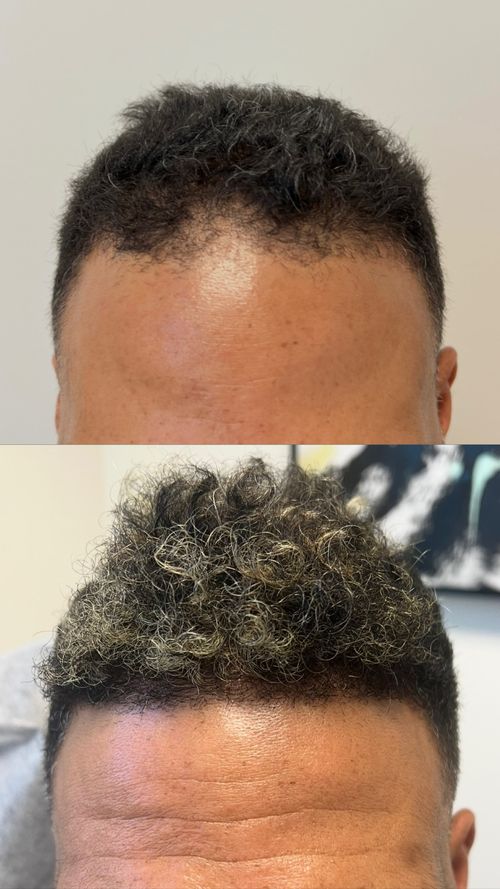 Our hair restoration before and after