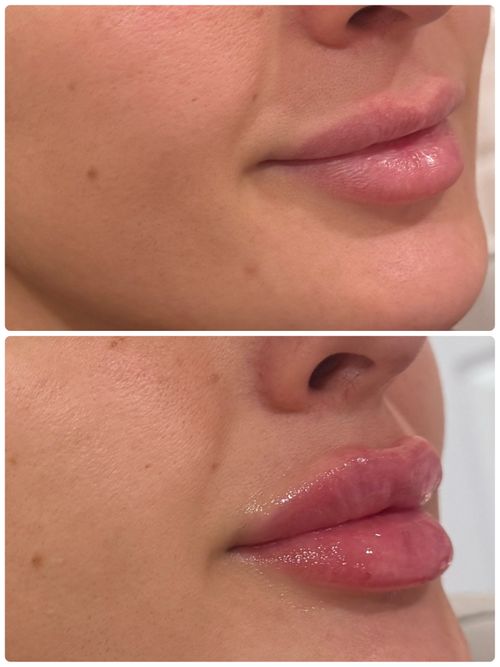 Our lip filler before and after