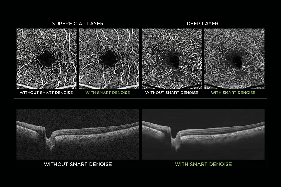 Infográfico comparativo mostrando um olho com cristalino opaco (catarata) e um olho com lente intraocular implantada recuperando a visão