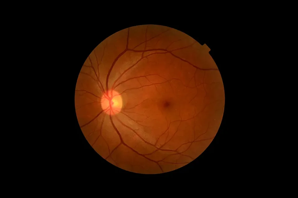 Infográfico comparativo mostrando um olho com cristalino opaco (catarata) e um olho com lente intraocular implantada recuperando a visão