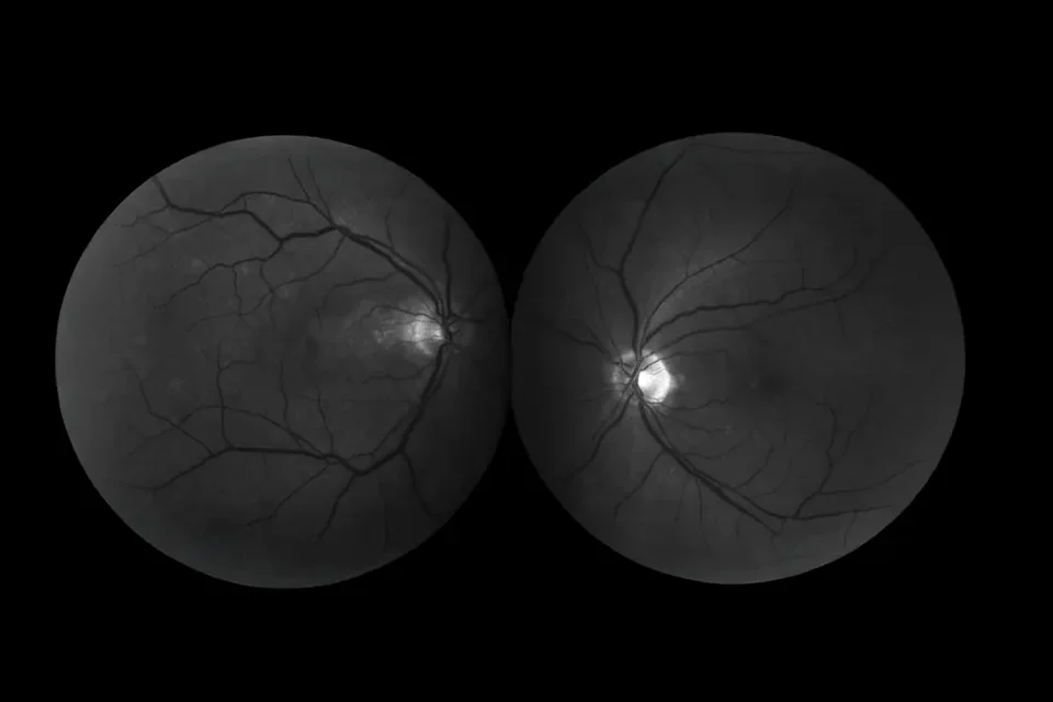 Infográfico comparativo mostrando um olho com cristalino opaco (catarata) e um olho com lente intraocular implantada recuperando a visão