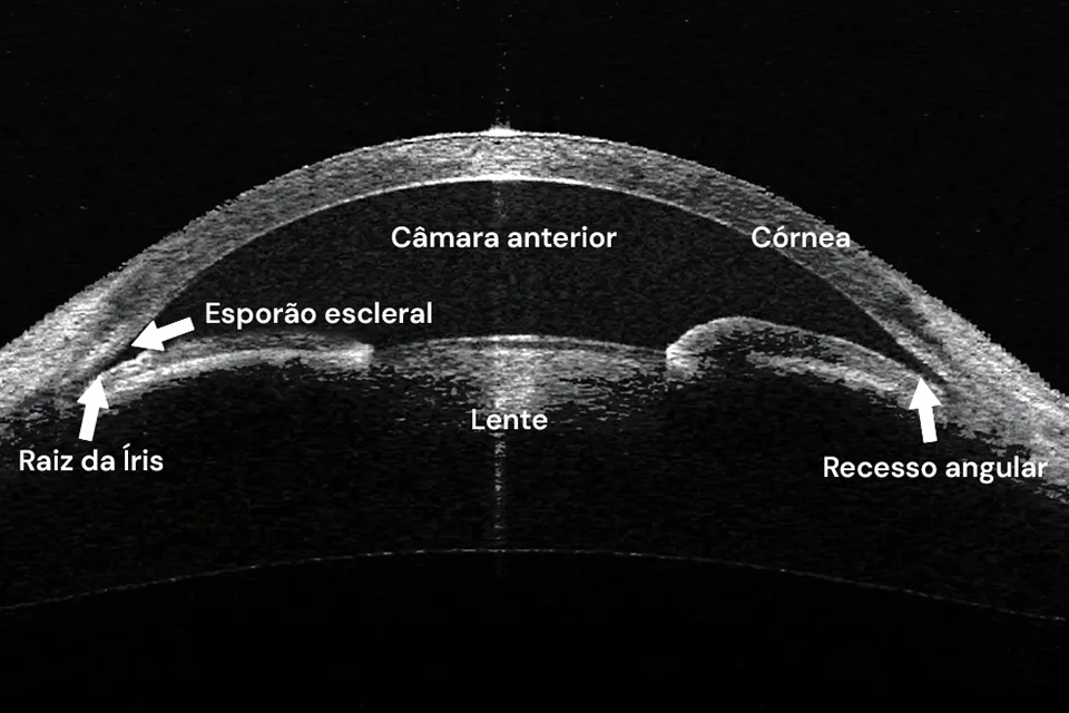 Infográfico comparativo mostrando um olho com cristalino opaco (catarata) e um olho com lente intraocular implantada recuperando a visão