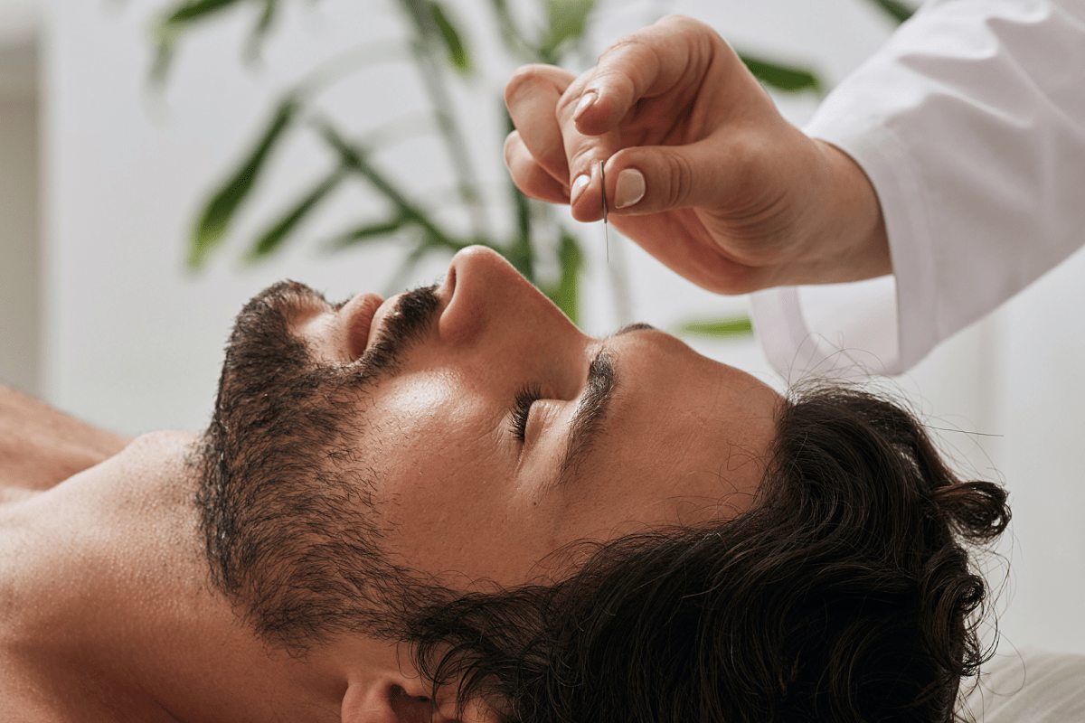 Man lying down receiving acupuncture to the forehead.