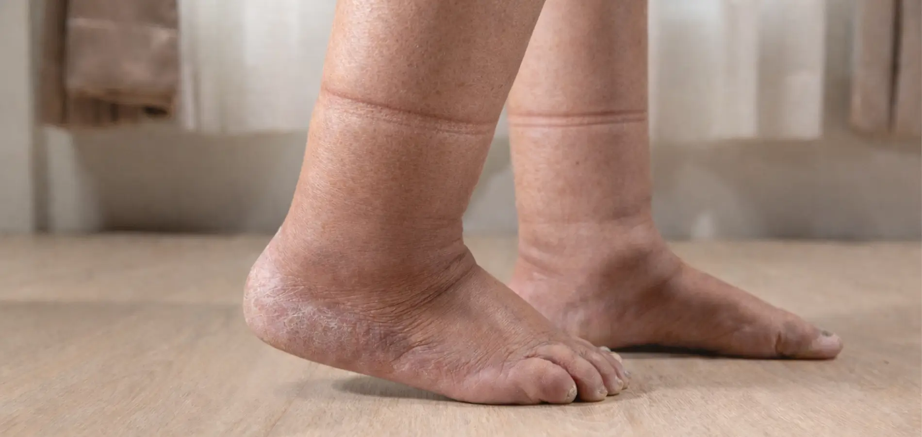 Hævede fødder med mærker efter sokkerne