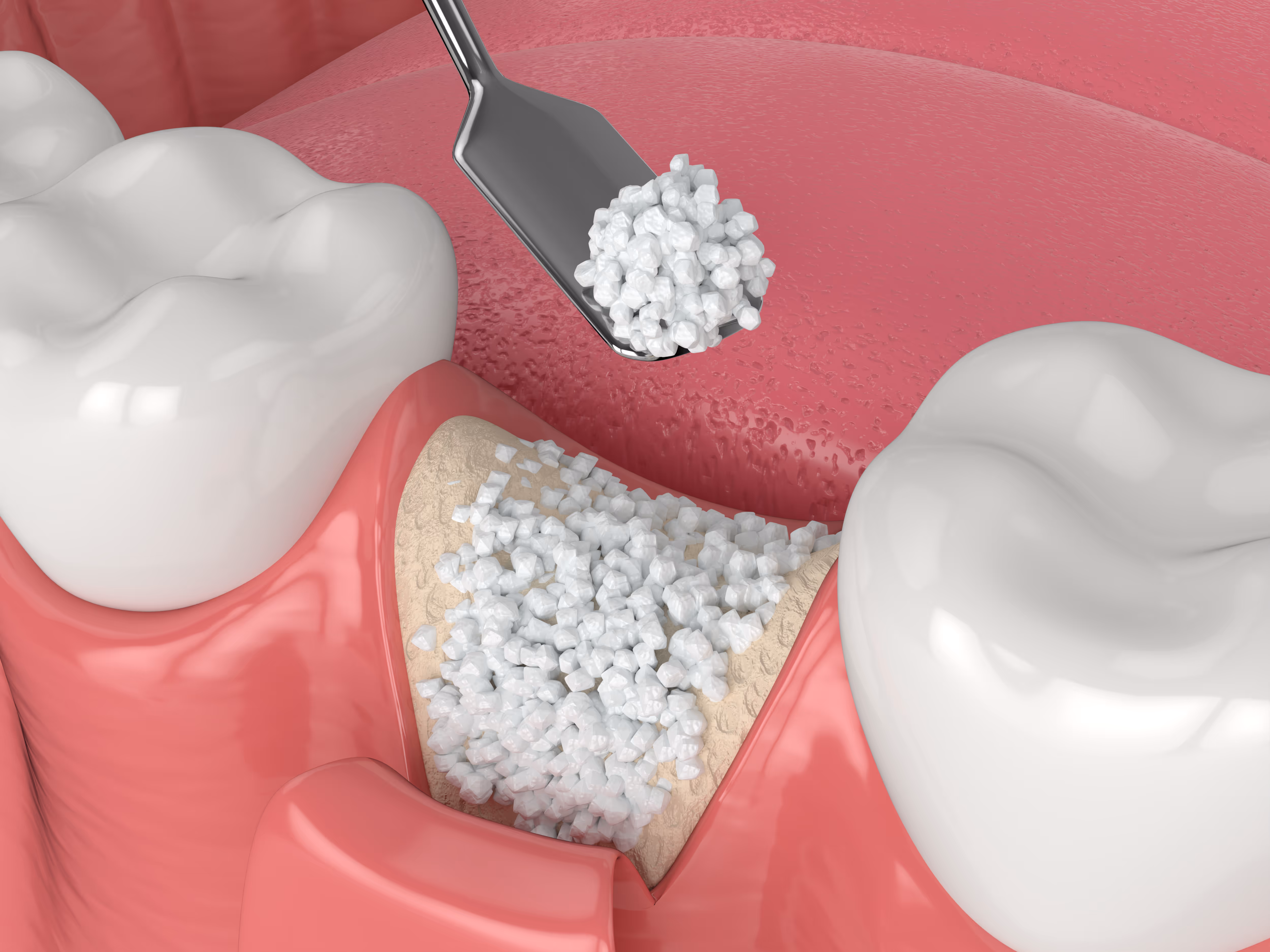 Close-up illustration of dental bone grafting procedure showing bone graft material being applied to exposed jawbone between two teeth.