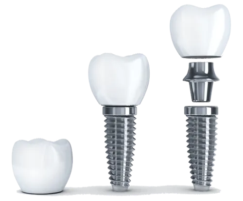 Illustration showing three stages of a dental implant: a dental crown, a dental crown attached to an implant screw, and a dental crown being mounted on an abutment connected to an implant screw.