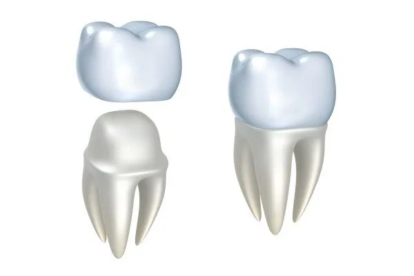 Image of a dental crown being placed on top of a tooth, illustrating the fitting process.