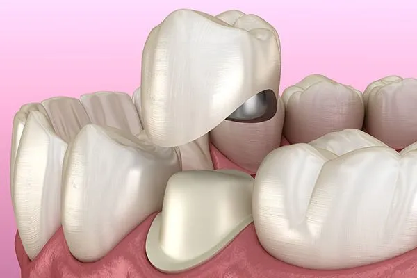 3D illustration of a dental crown being placed over a prepared tooth on pink gums.