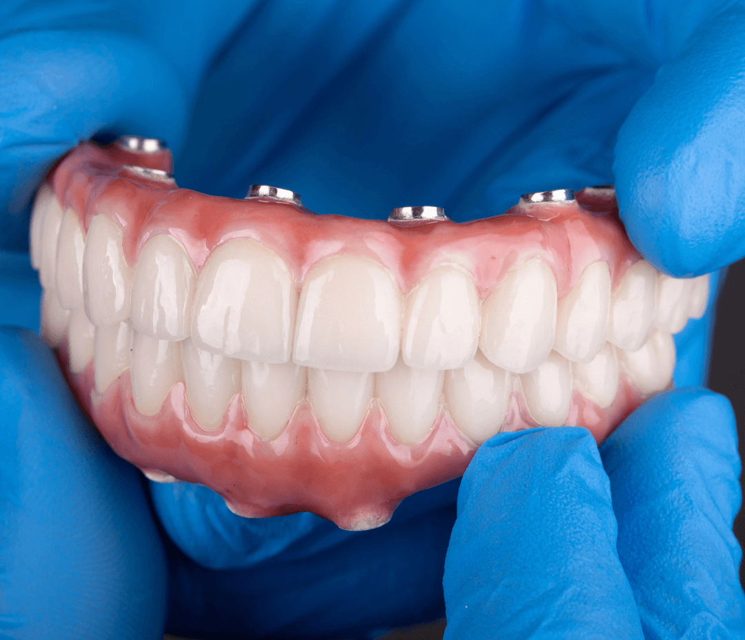 Gloved hands holding a set of dental prosthetics with artificial teeth and gum model.