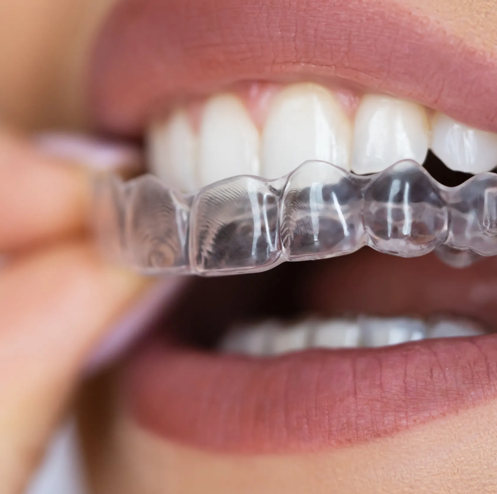 Close-up of a person holding a clear dental aligner near their white teeth and lips.