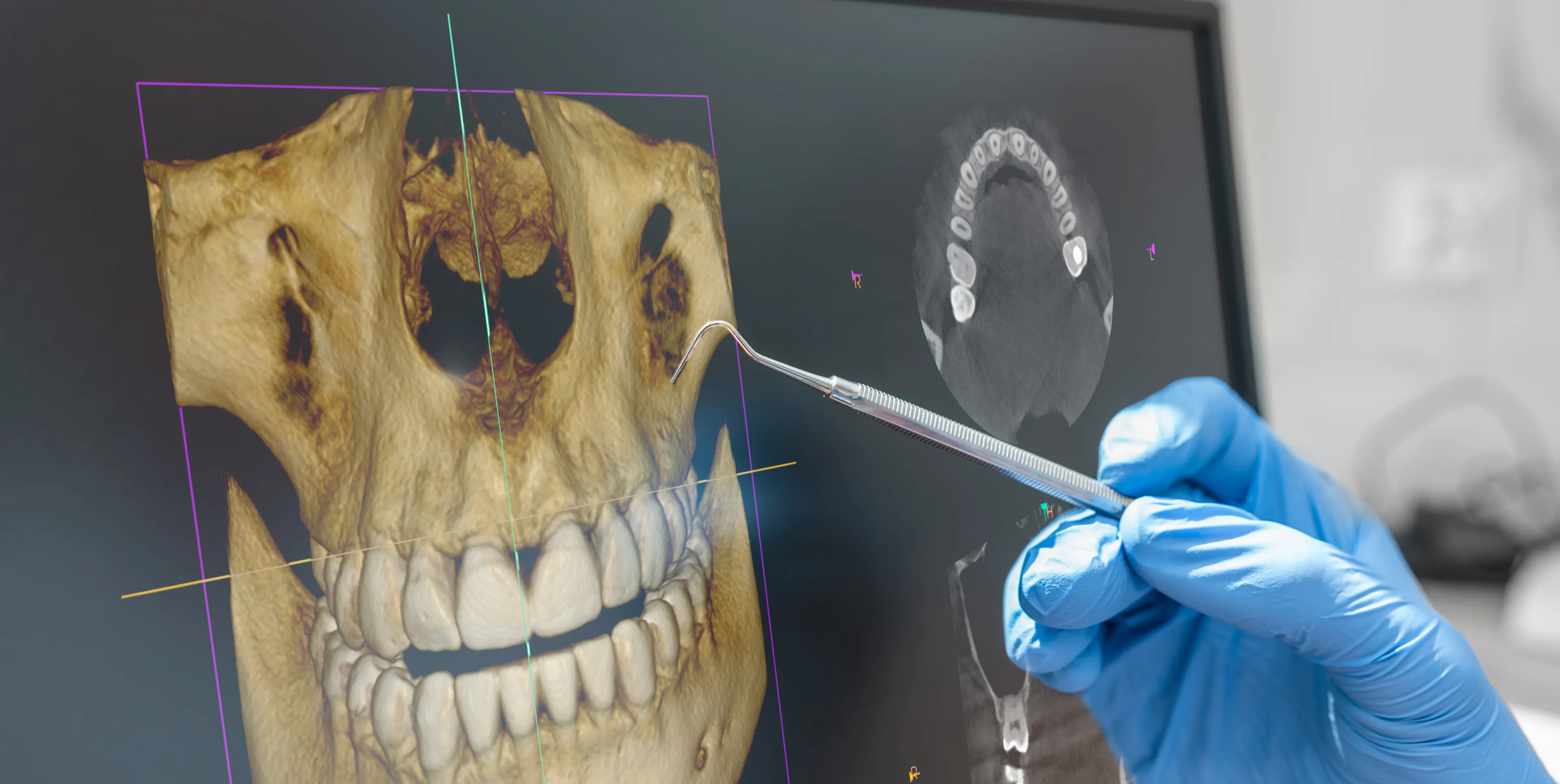 Dental professional wearing blue gloves holding a dental tool pointing at a 3D scan and X-ray of jaw and teeth on a computer screen.