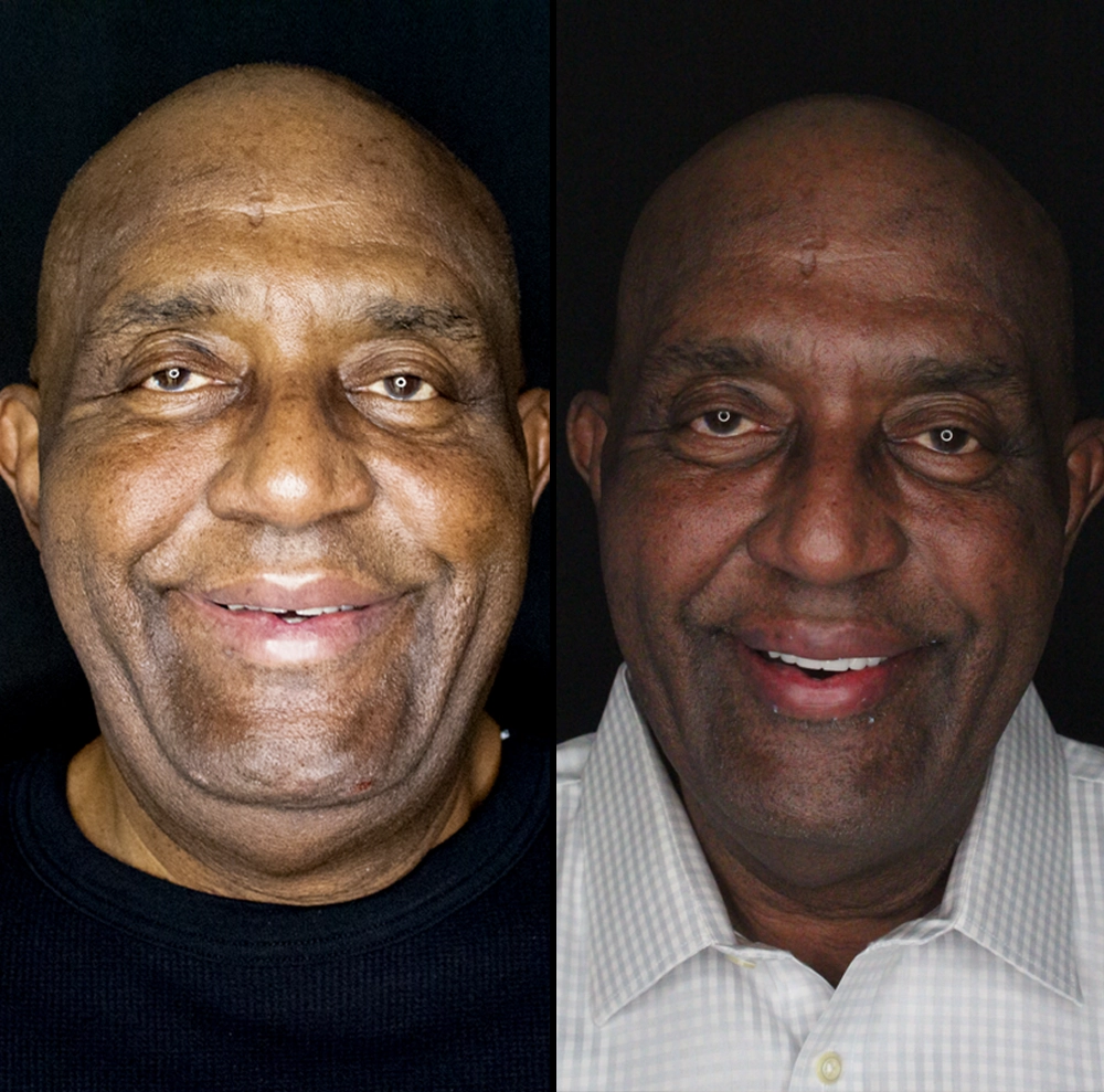 before and after photo of man with new teeth and secure smile