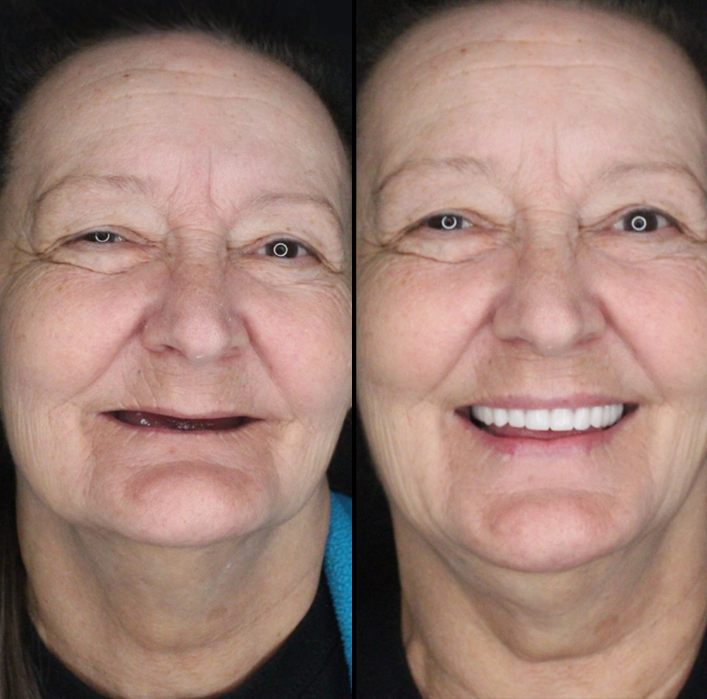 before and after photo of woman with new teeth and secure smile