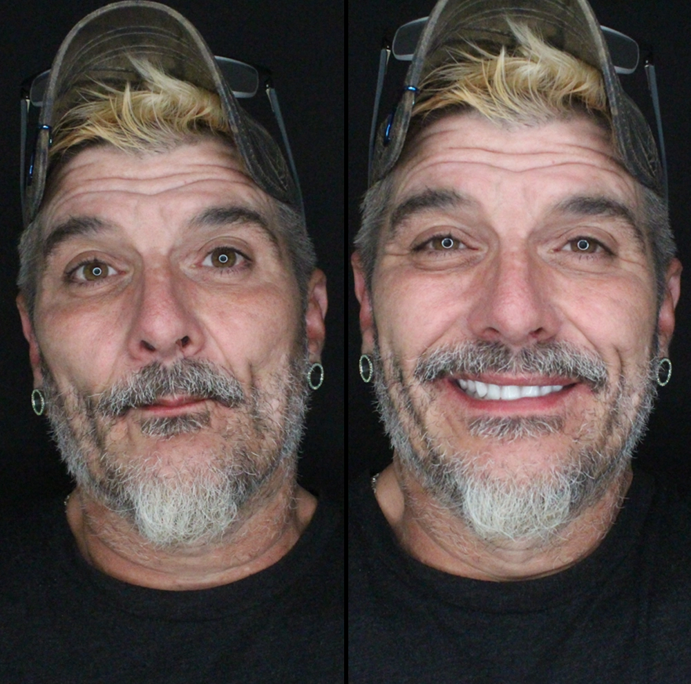 before and after photo of man with new teeth and secure smile