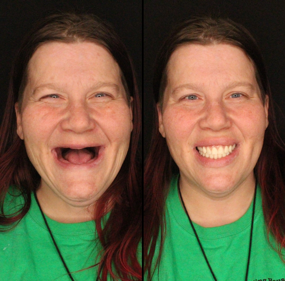 before and after photo of woman with new teeth and secure smile