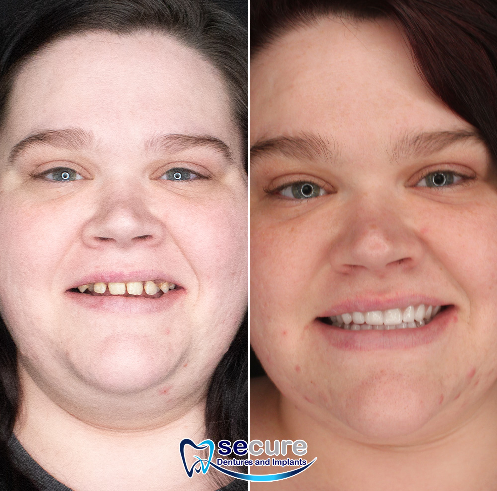 before and after image of young woman smiling with new teeth