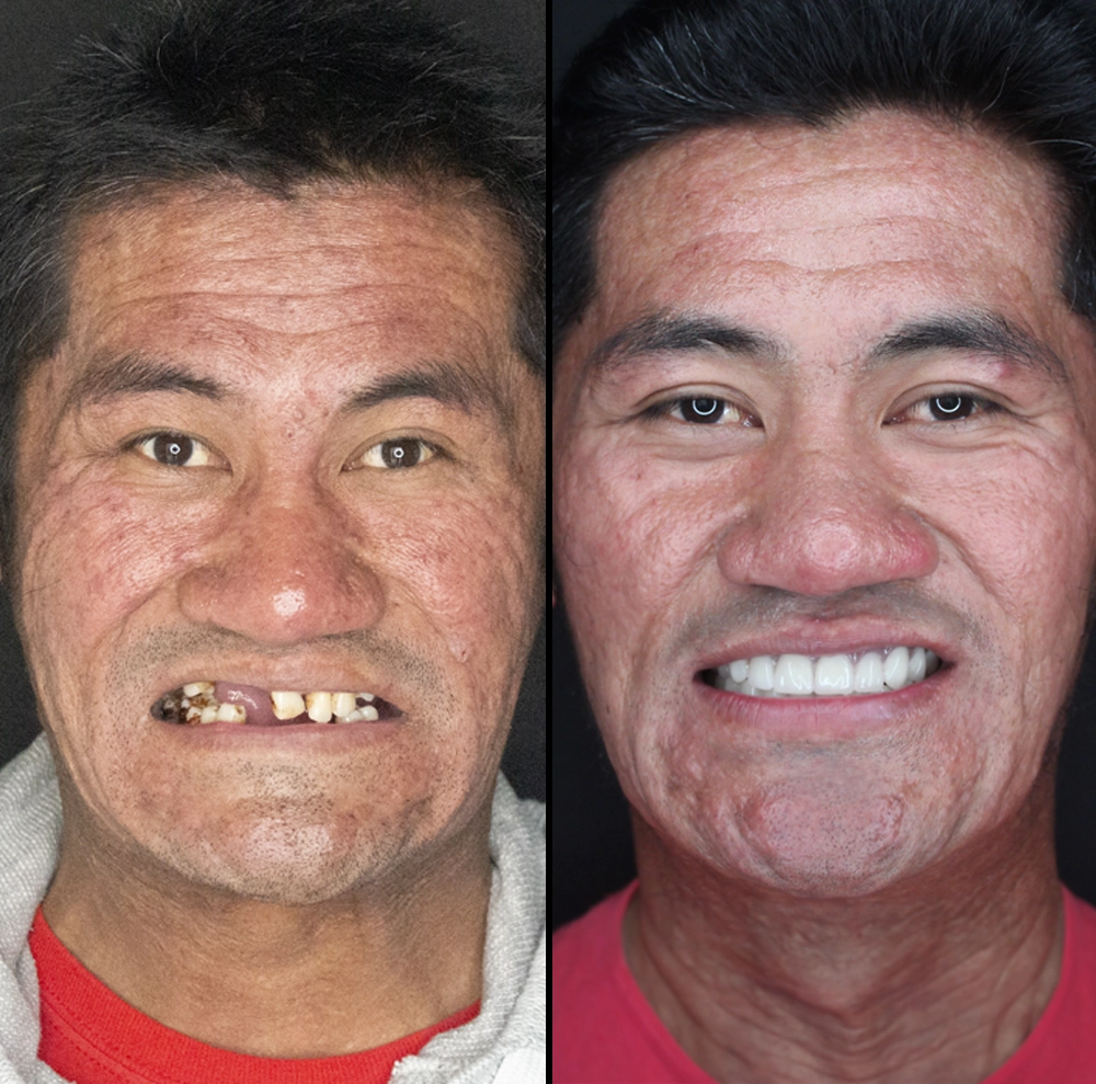 before and after photo of man with new teeth and secure smile