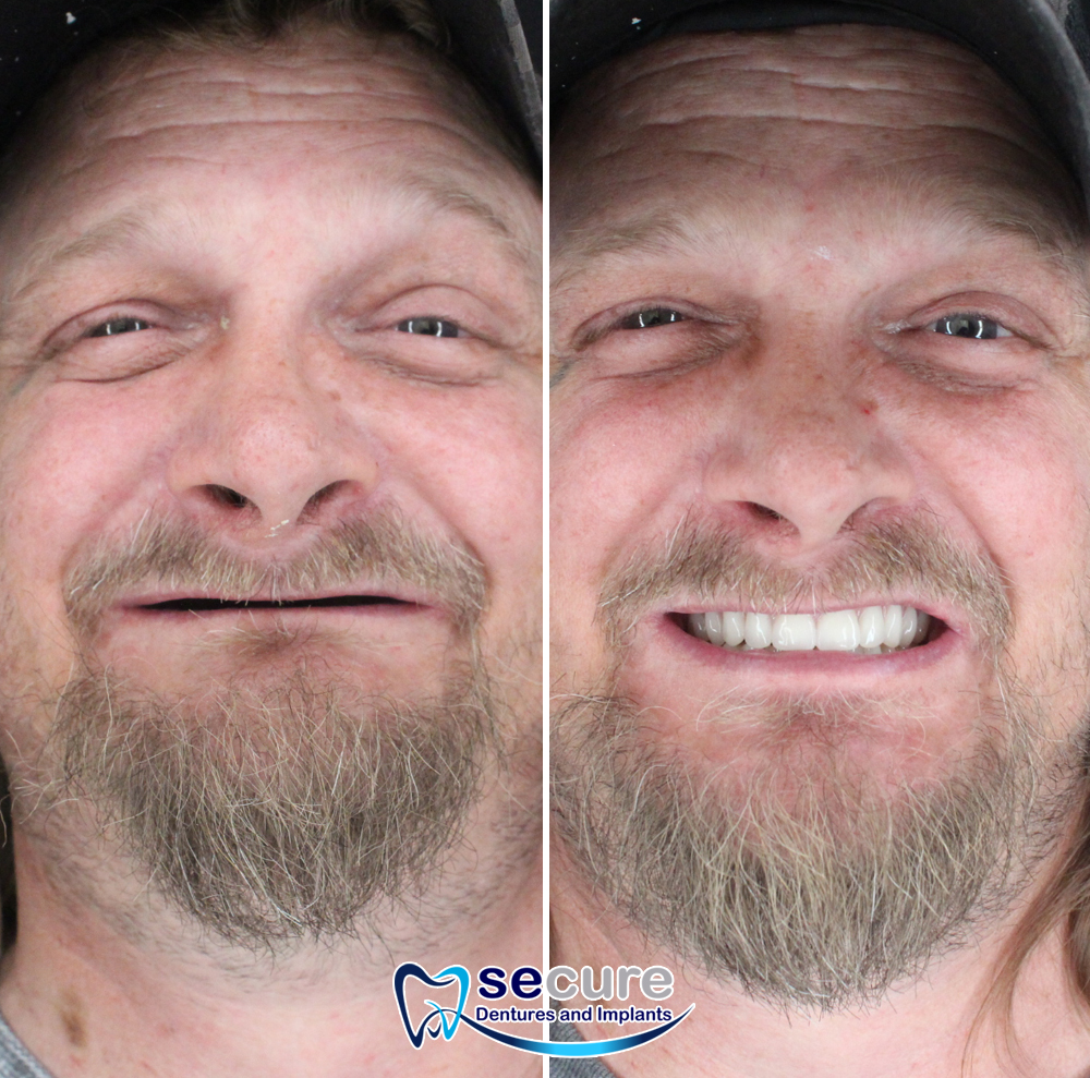 before and after image of man with goaee smiling with new teeth