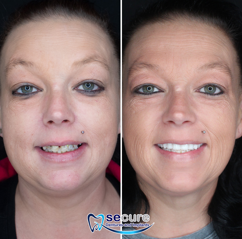 before and after image of young woman smiling with new teeth