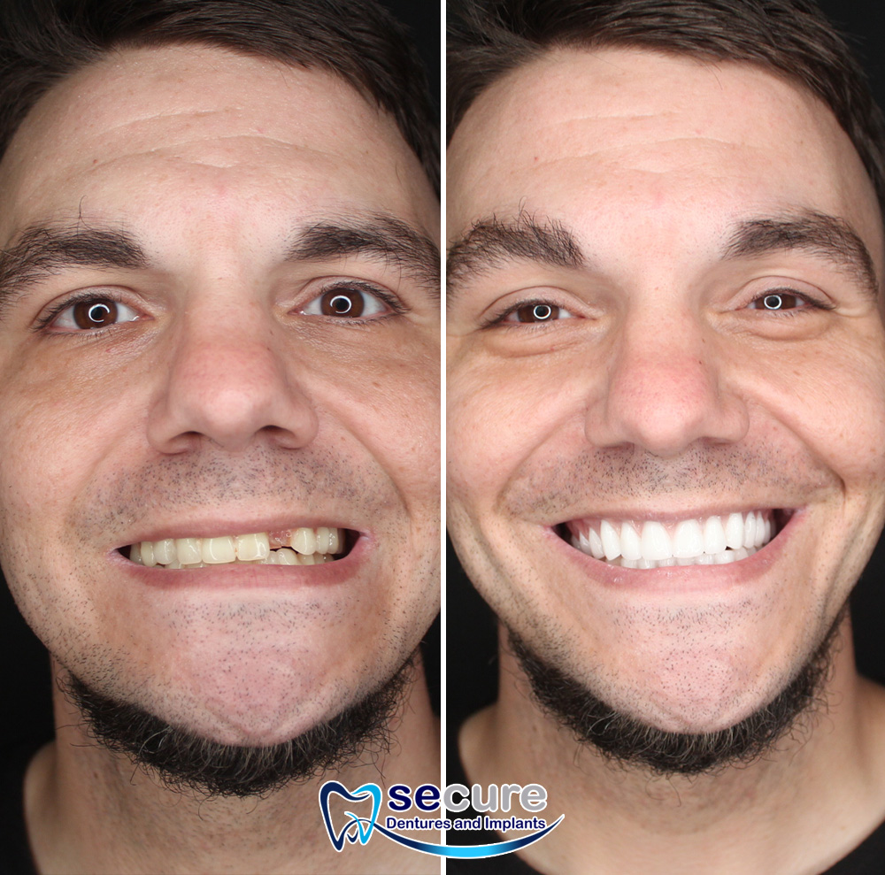 before and after image of man with beard smiling with new teeth
