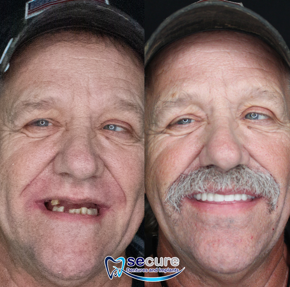 before and after image of man with mustache smiling with new teeth