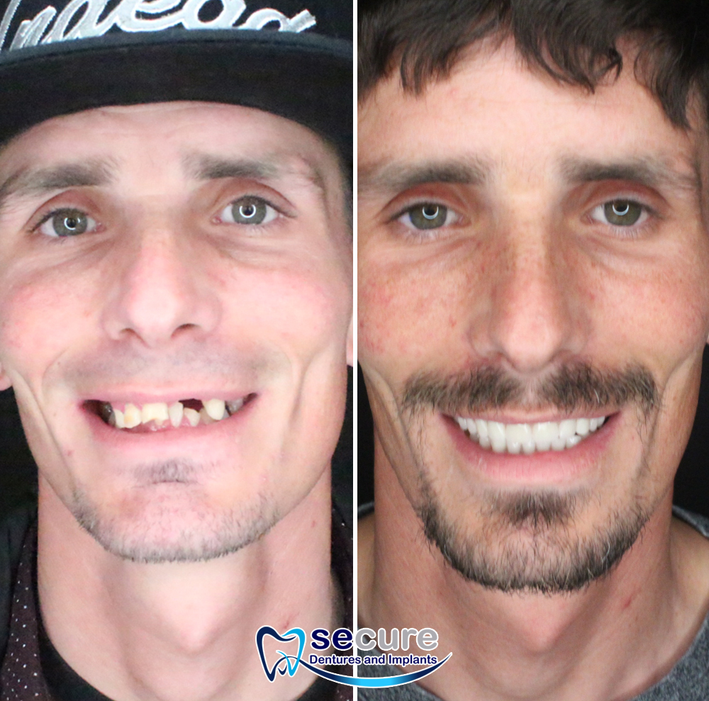 before and after image of young man smiling with new teeth