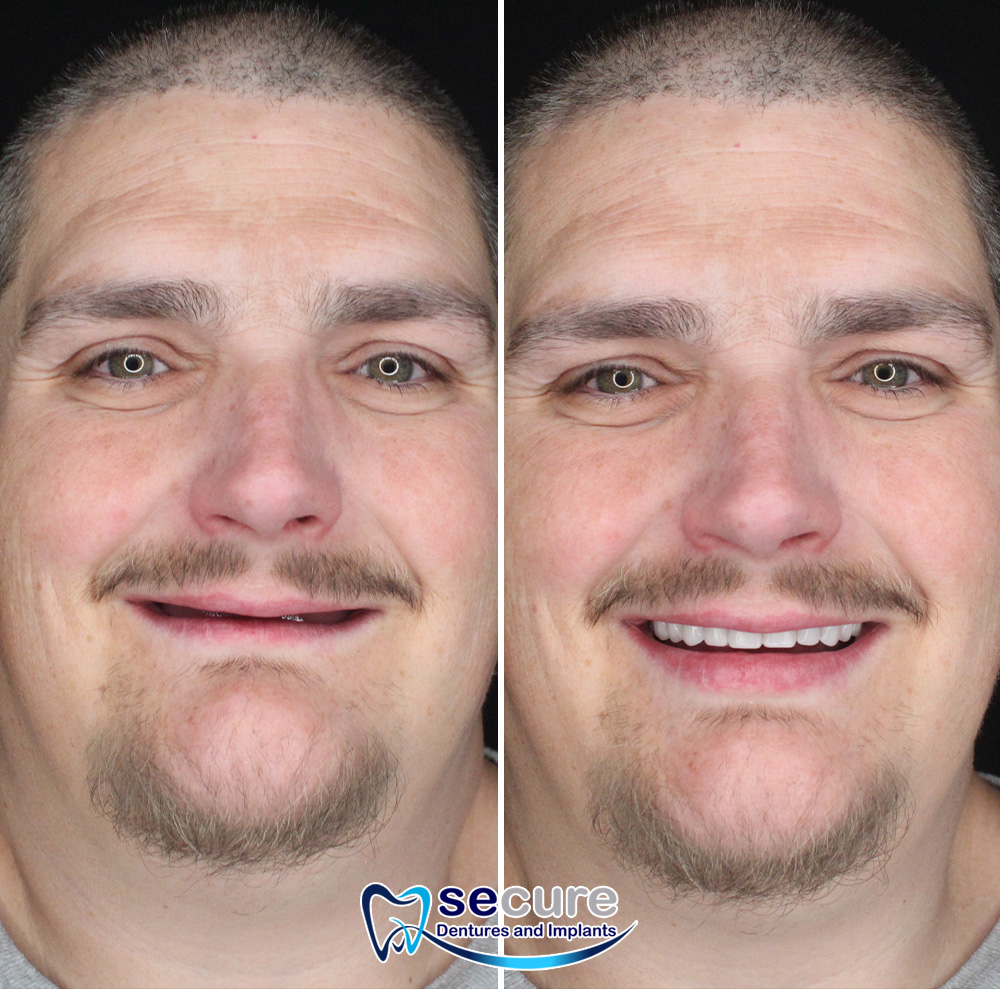 before and after image of man with goatee smiling with new teeth
