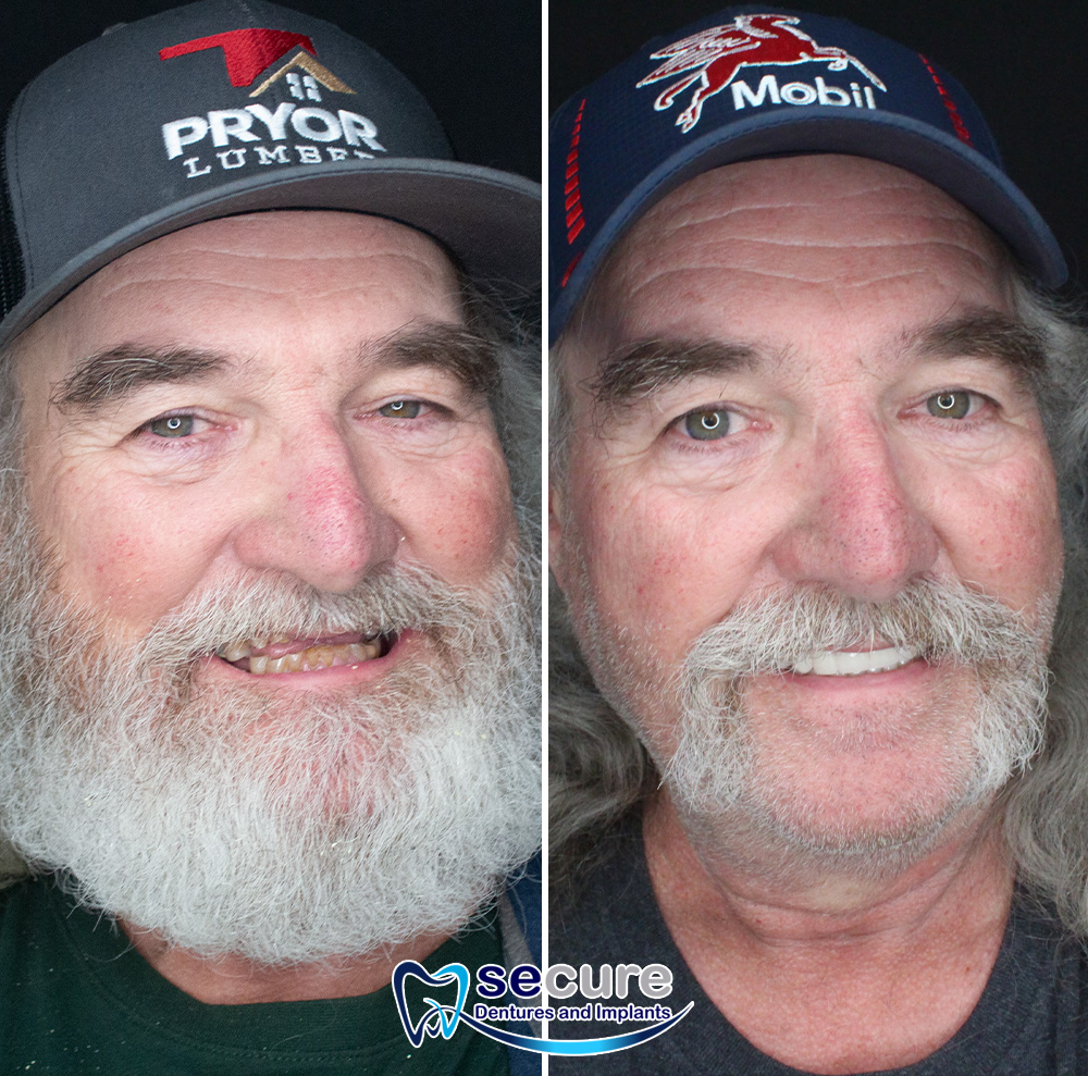 before and after of a man with gray beard smiling with new teeth