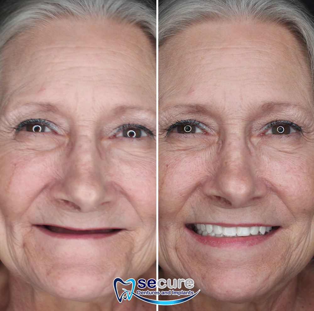 before and after image of woman smiling with new teeth