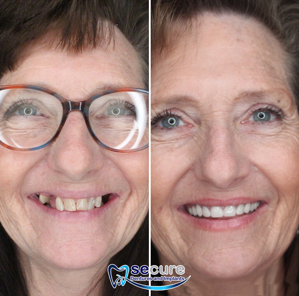 before and after image of woman with glasses smiling with new teeth