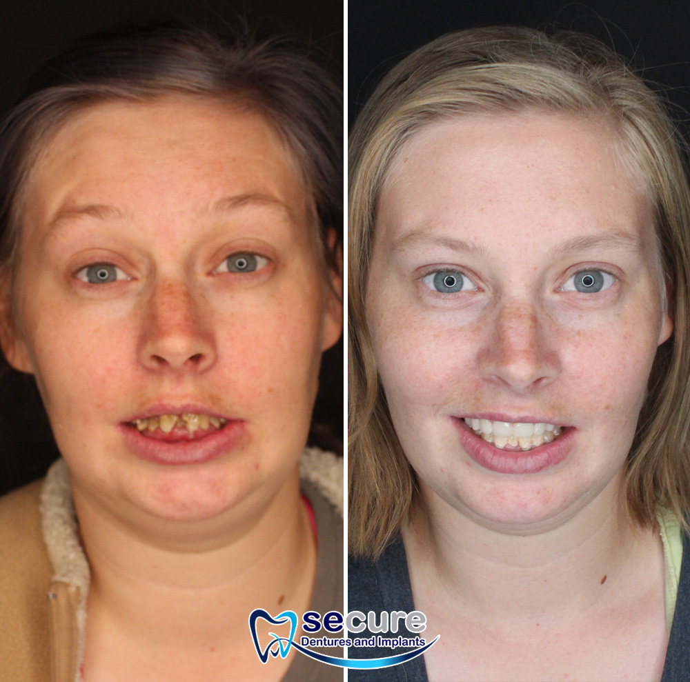 before and after image of young woman with blonde hair smiling with new teeth
