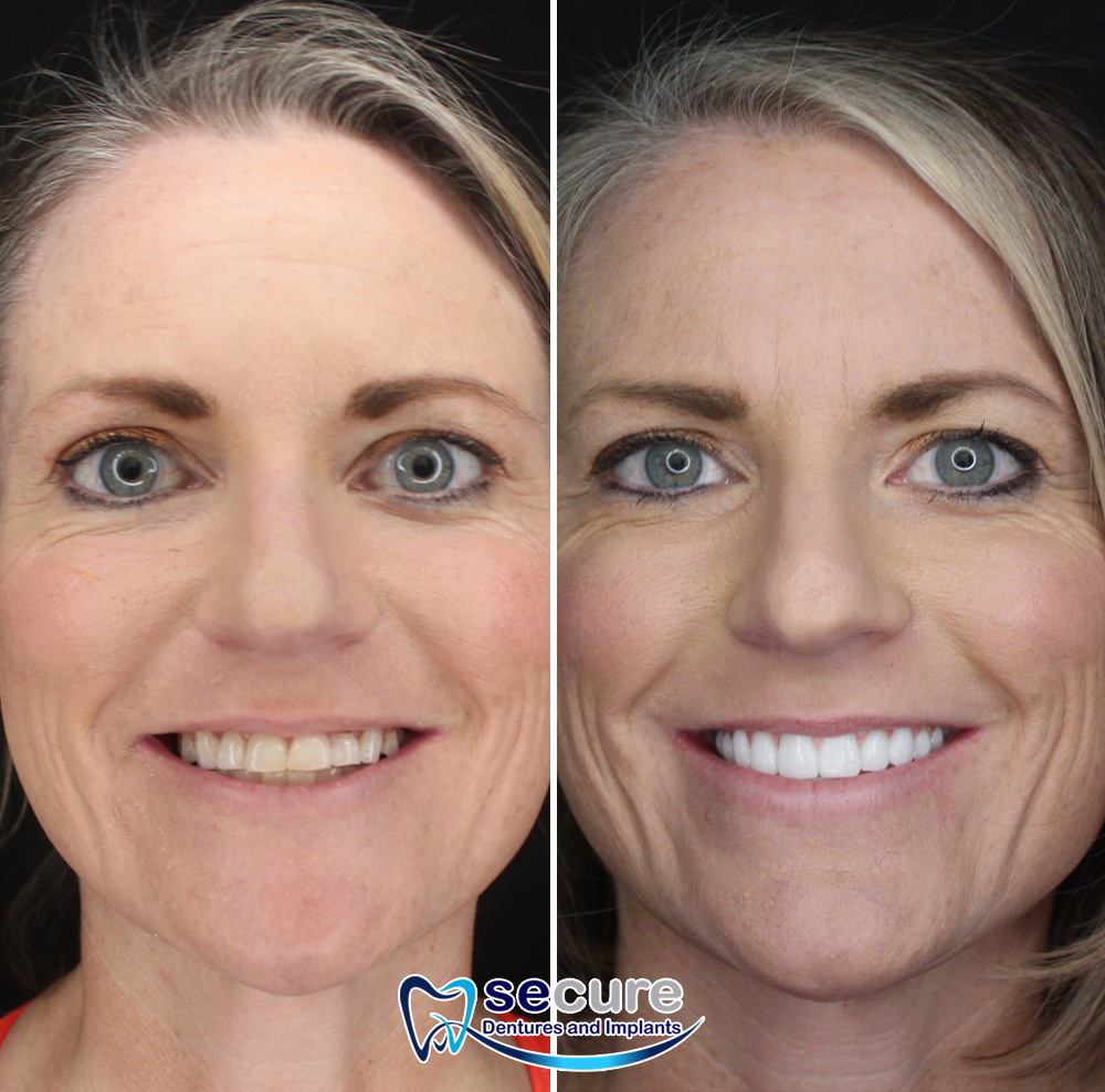 before and after image of woman smiling with new teeth