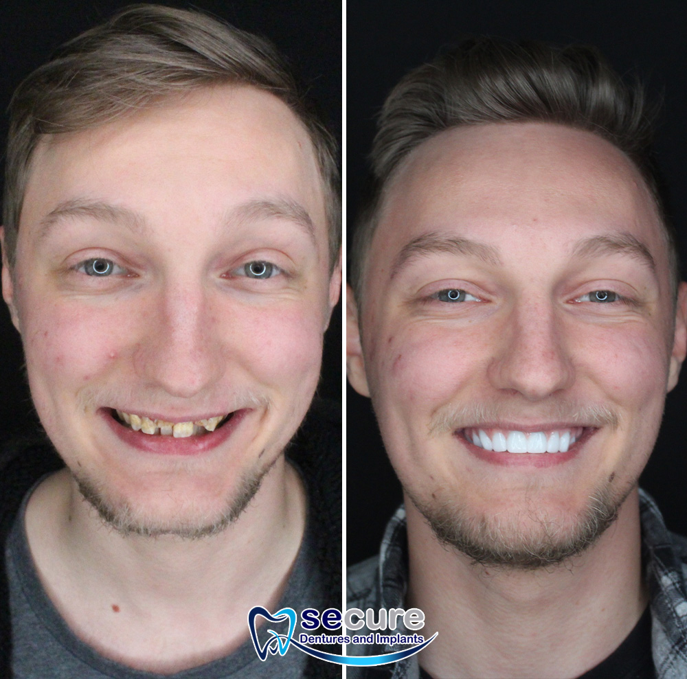before and after of young man smiling with new teeth