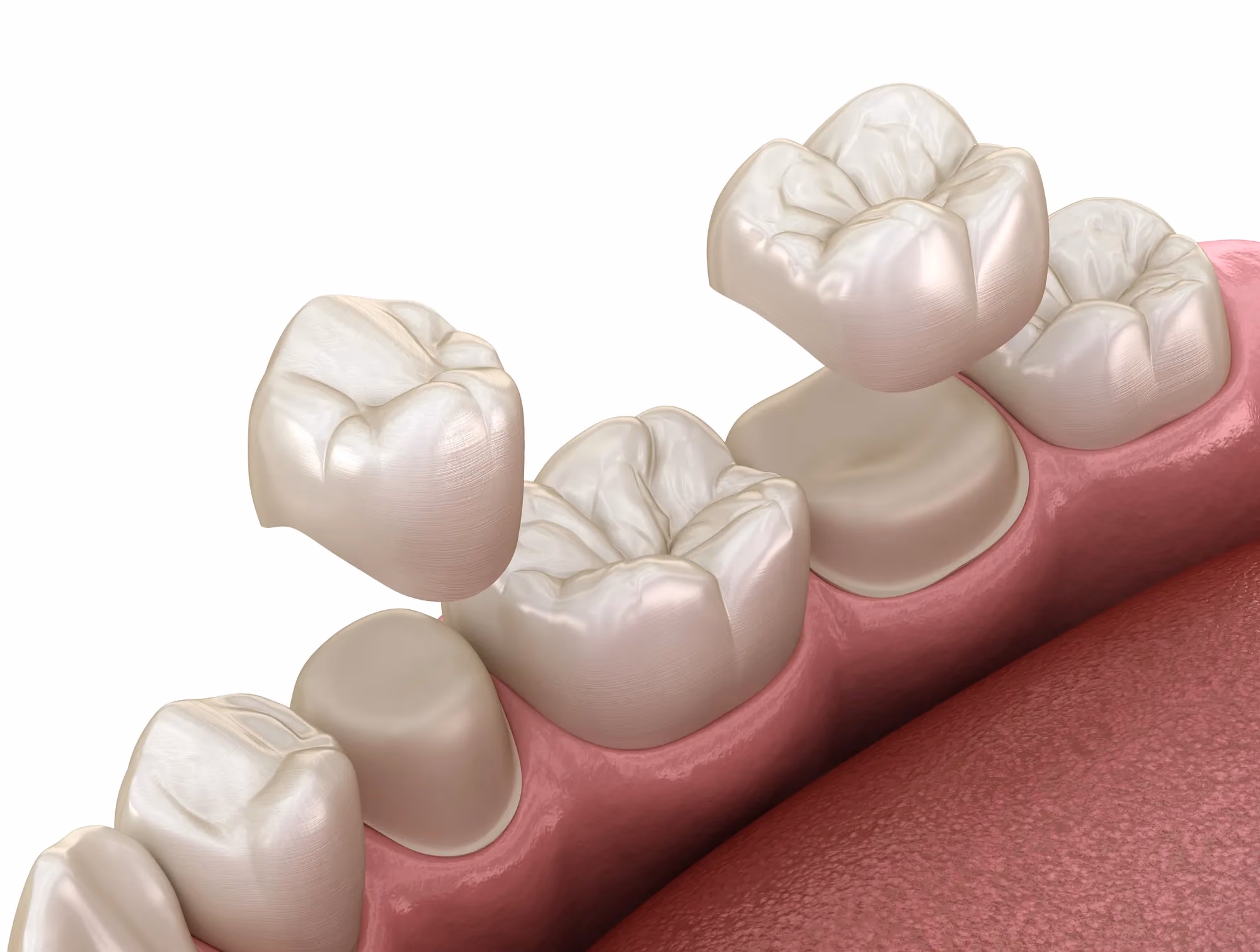 3d illustration of dental crowns