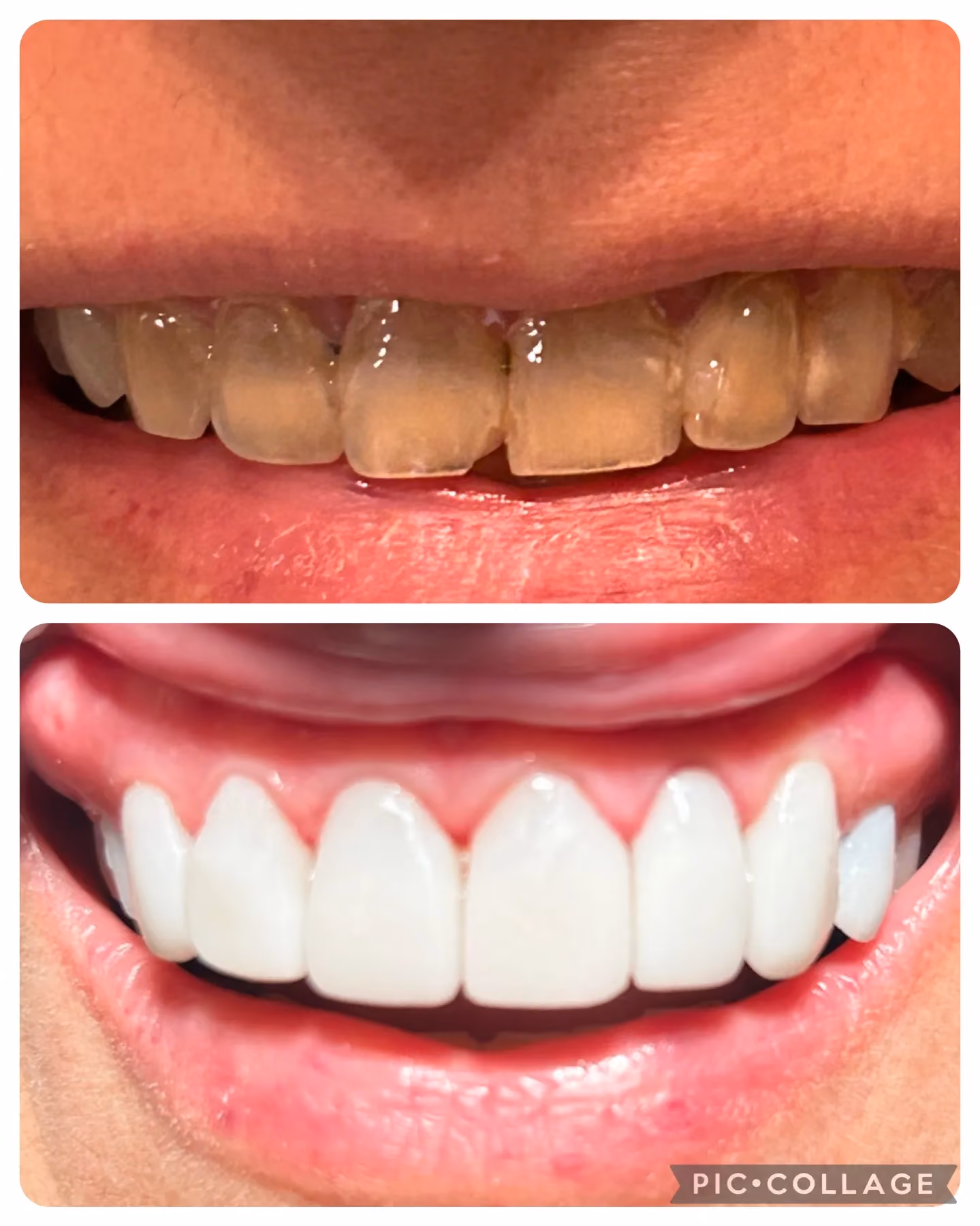 Smile transformation before and after 5