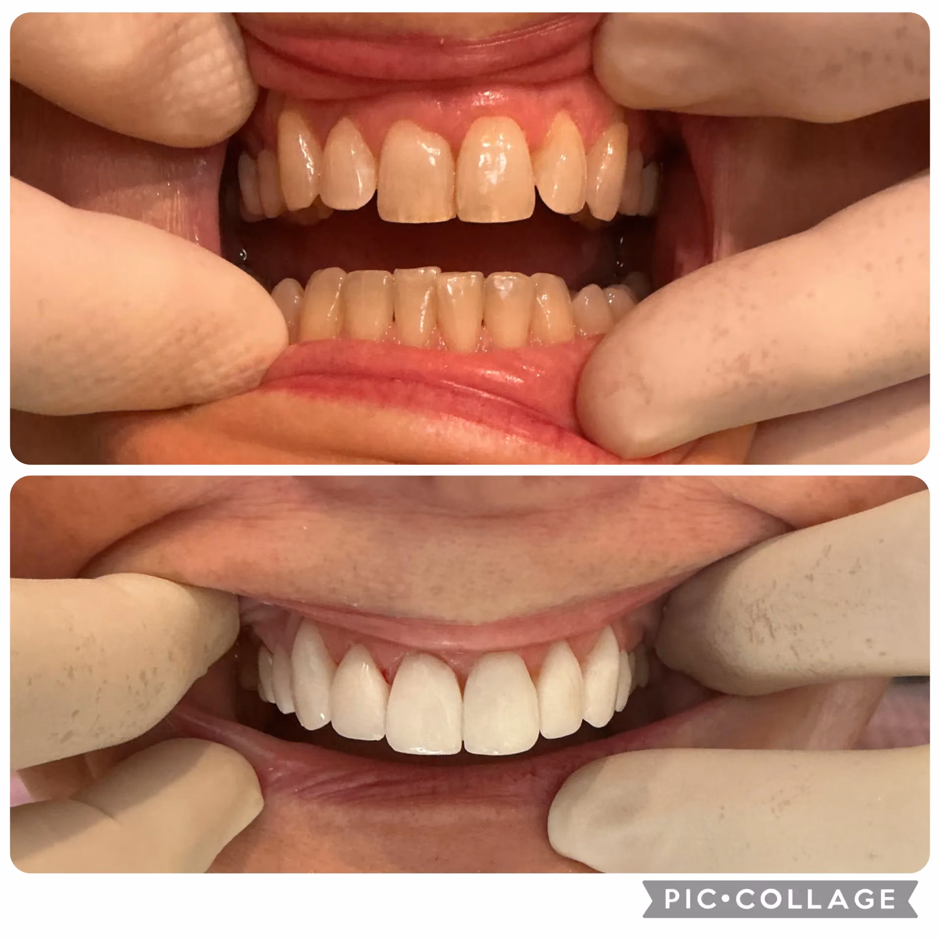 Smile transformation before and after 14