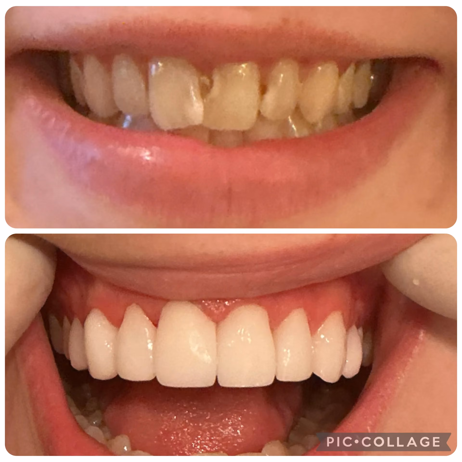 Smile transformation before and after 15