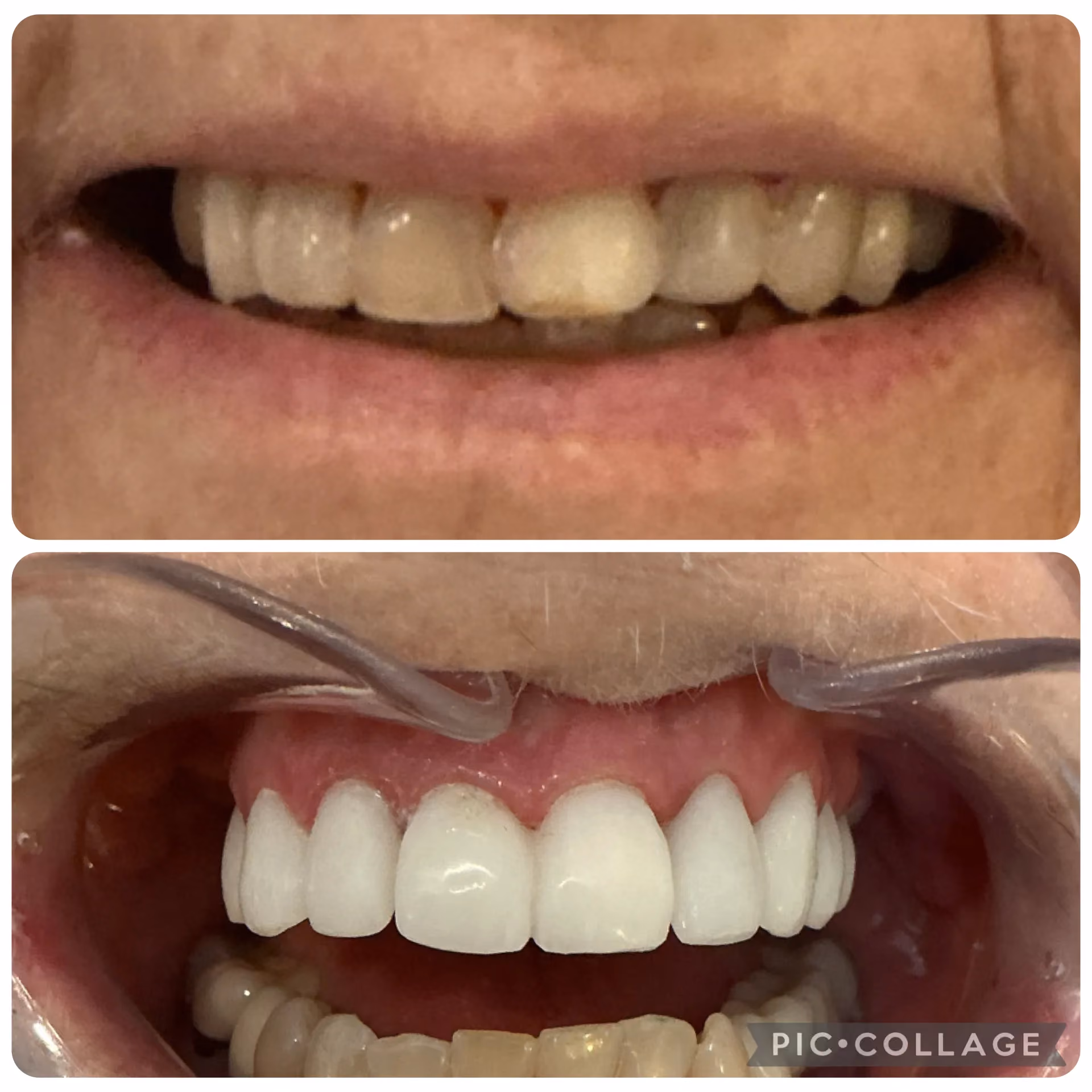 Smile transformation before and after 16