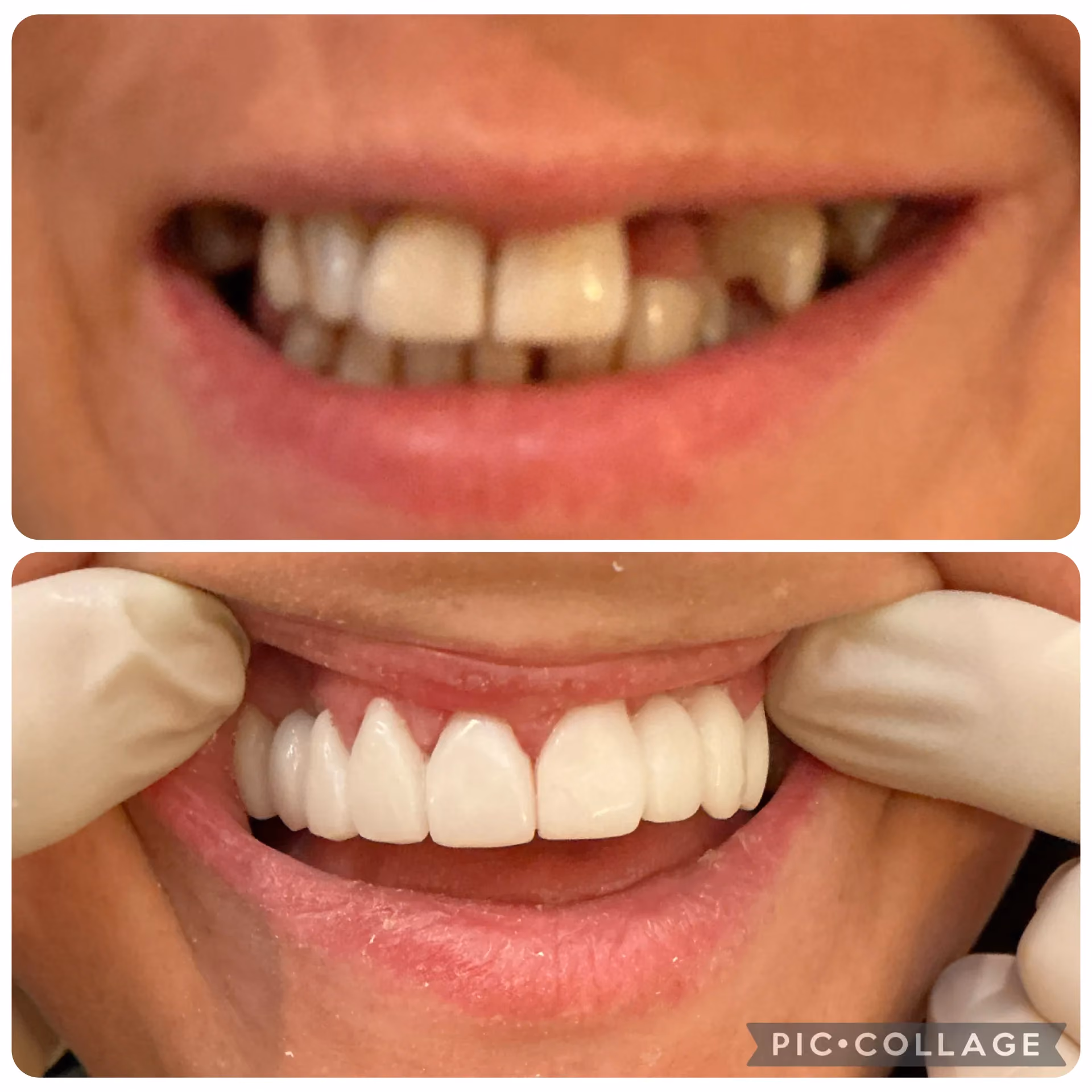 Smile transformation before and after 18