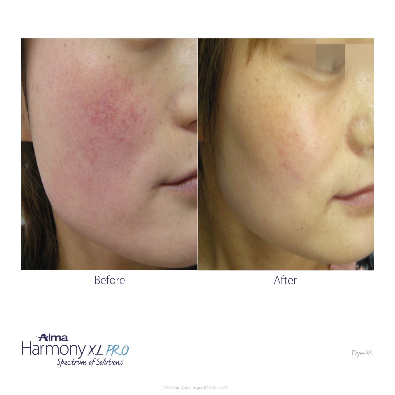 clearlift before and after