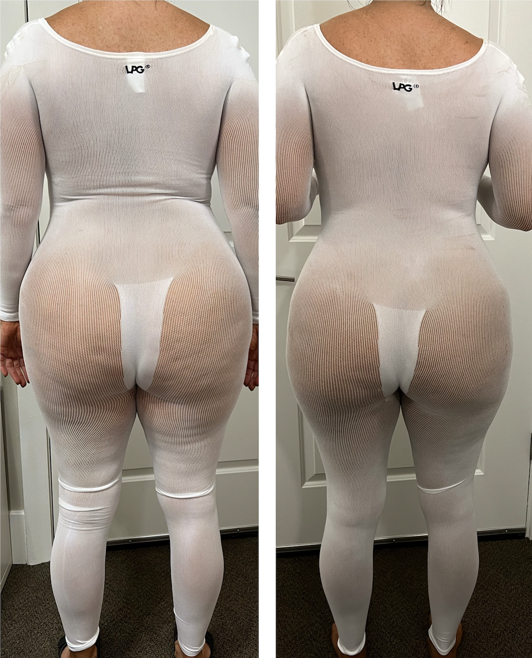Body contouring